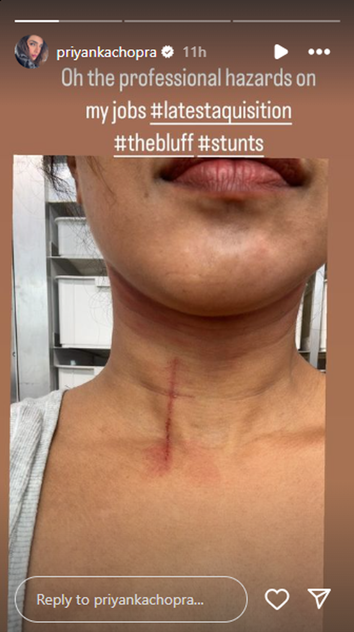 Priyanka Chopra Jonas posted a selfie of her injury on Instagram Stories