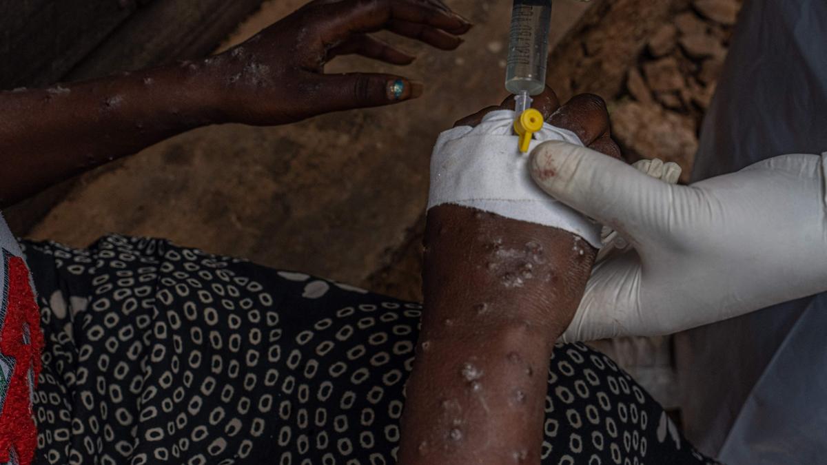 WHO says droplets a ‘minor’ route of mpox transmission