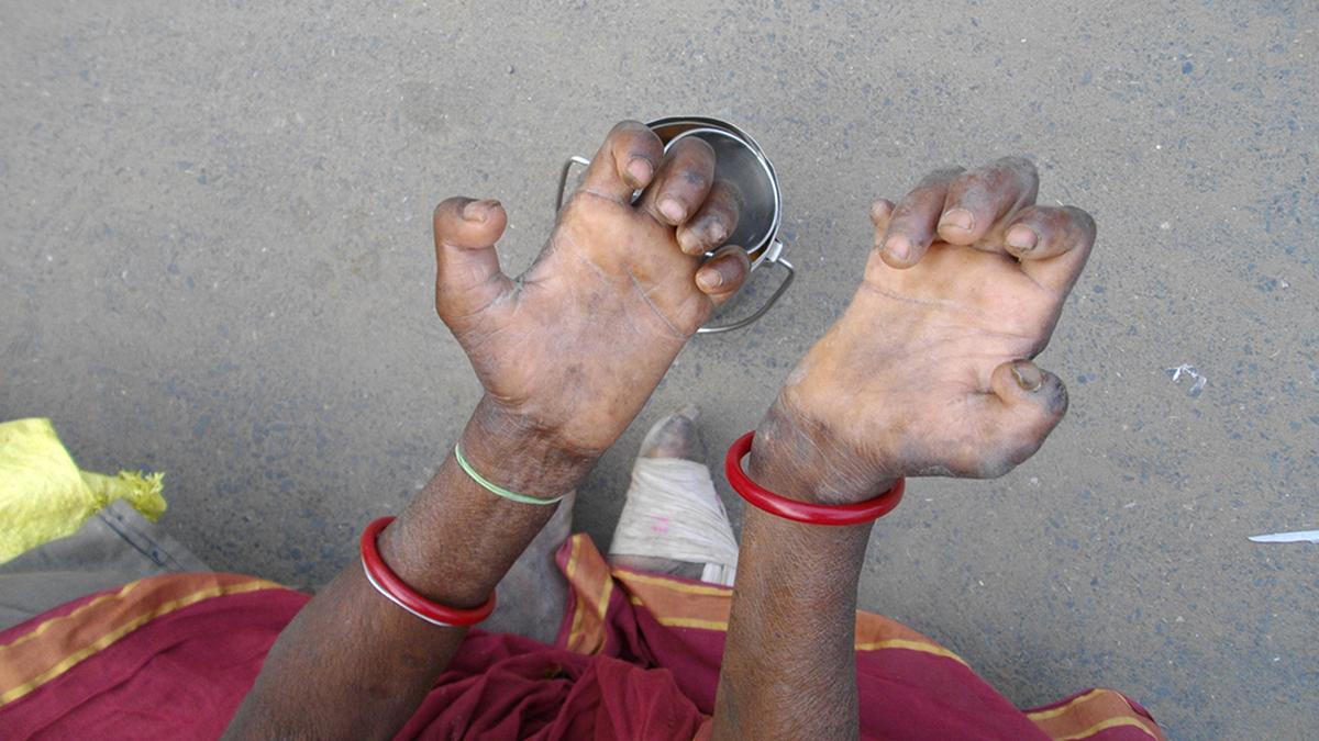 The leprosy story: India’s path towards a stigma-free society