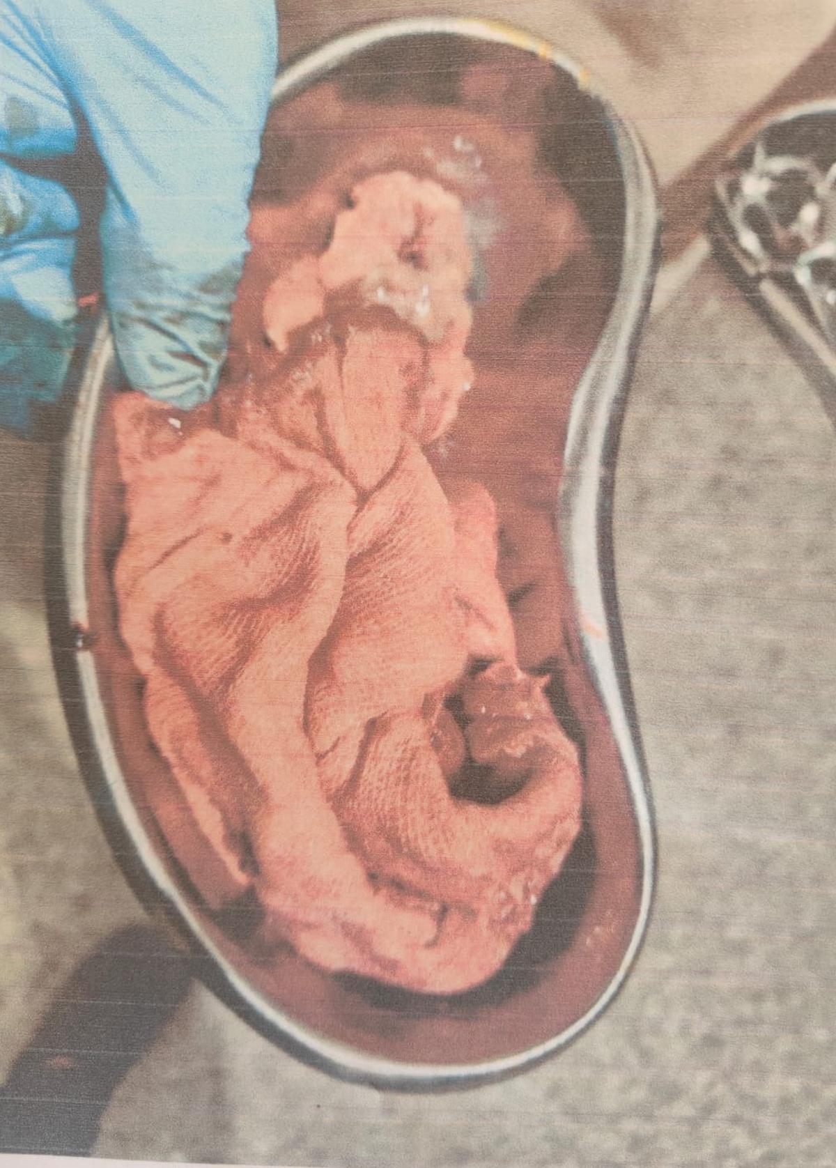 The surgical mop that was inside a woman following a C-section in Puttur was recently removed after a surgery. 