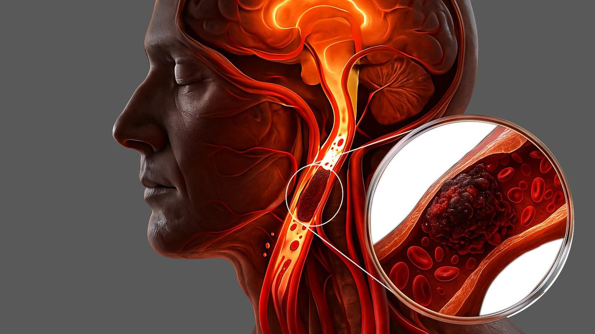When the Brain Sends a Warning: How India’s Young Professionals Are Facing a Silent Stroke Crisis