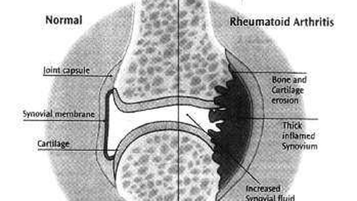 Study indicates incidence of rheumatoid arthritis increased 13 pc since 1990