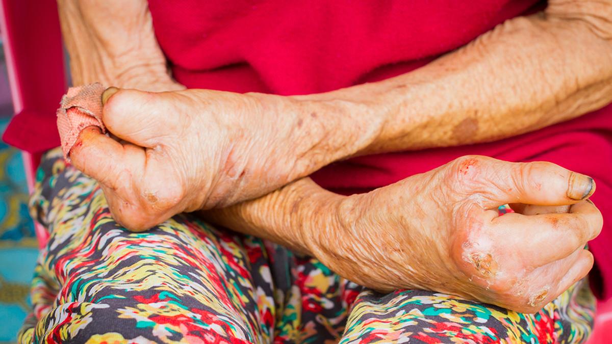 The link between leprosy and climate-change that we did not know about: an Indian story