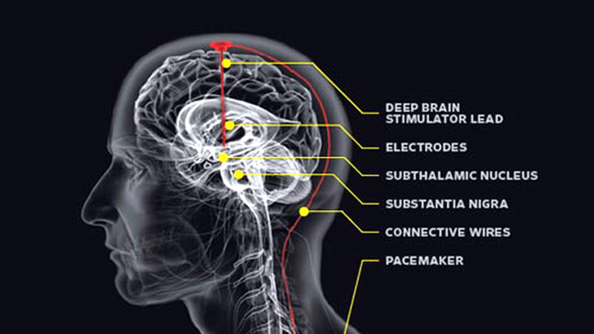 Hyderabad Man Makes Historic Recovery After Deep Brain Stimulation Surgery