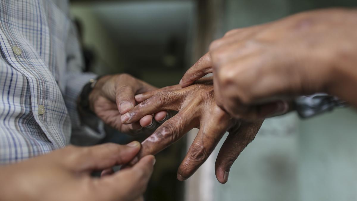 Prevalence rate of leprosy in three Karnataka districts higher than national average