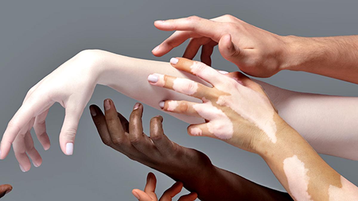 No health without skin health: a global call to end skin bleaching and prioritise dermatological equity - The Hindu 