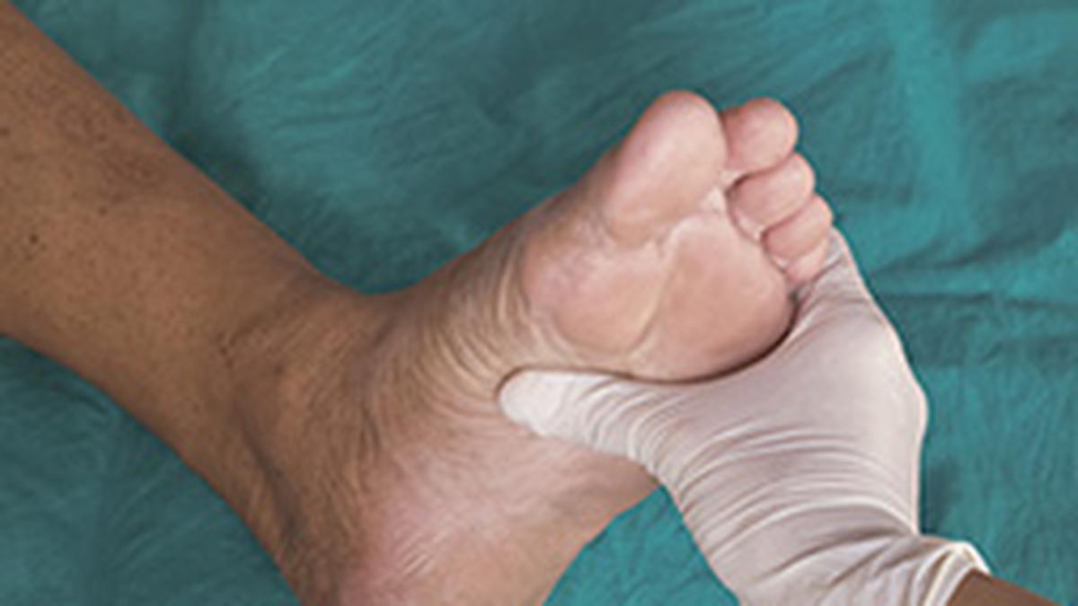 All you need to know about: Diabetic Foot