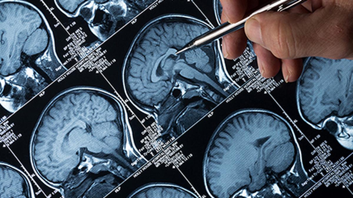 Healthcare reforms required globally to match progress in diagnosis, treatment of Alzheimer’s disease: researchers