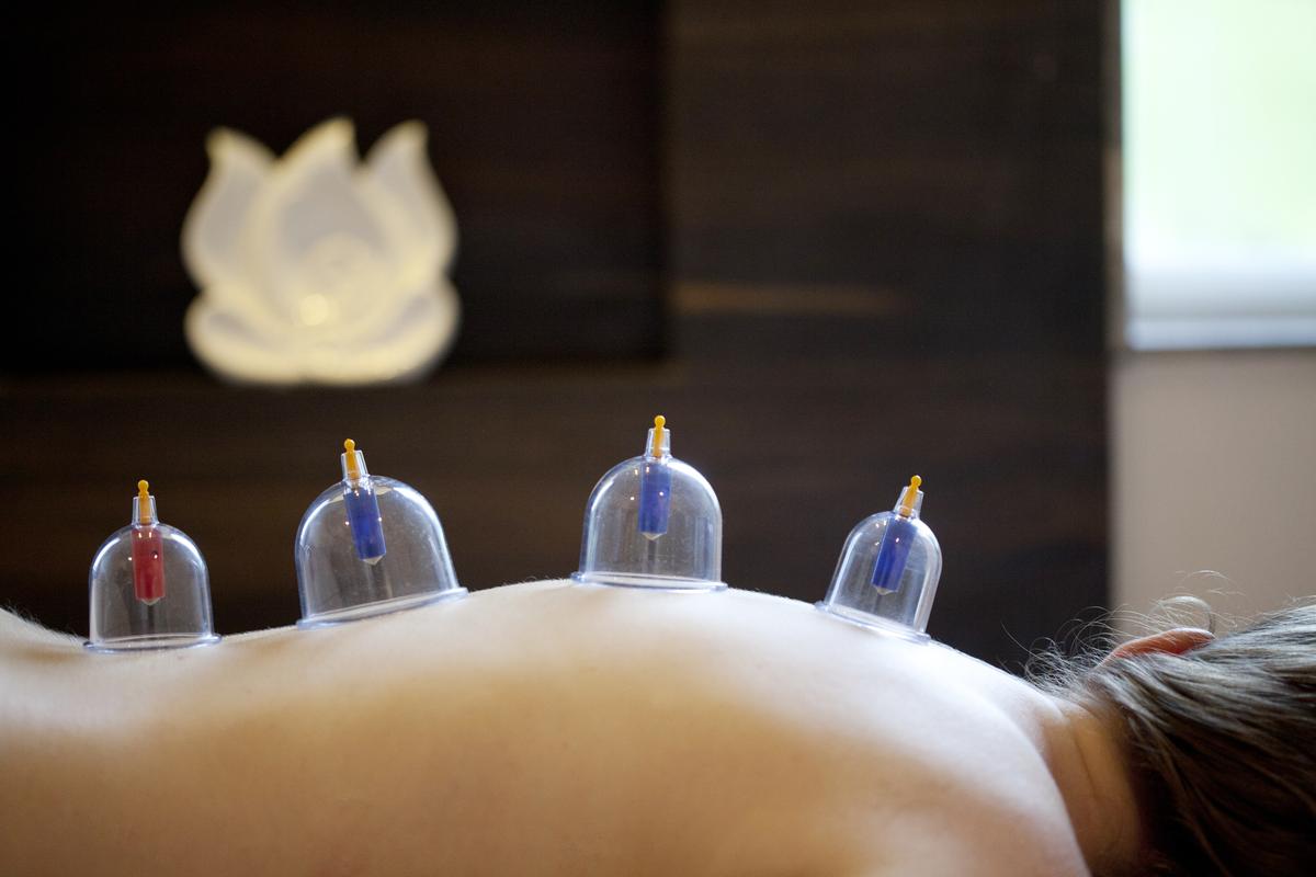 Cupping therapy helps relieve stress