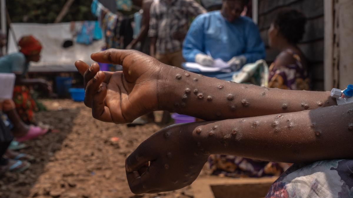 Why mpox vaccines are only just arriving in Africa after two years