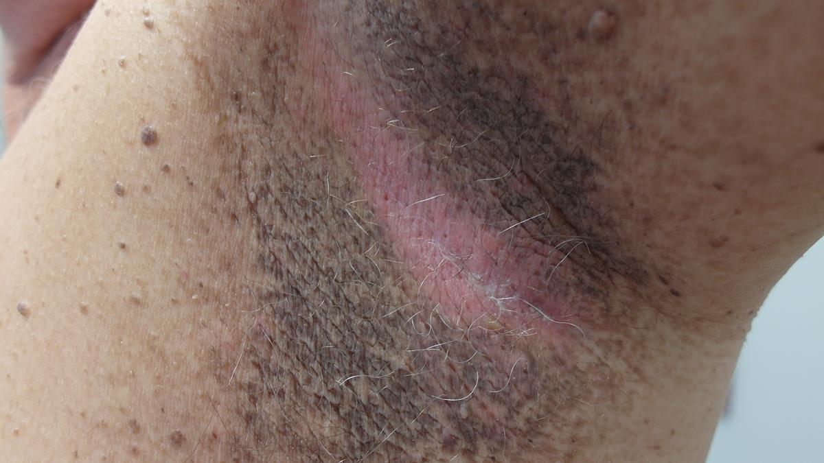 Acanthosis Nigricans: a skin change that may be pointing towards diabetes