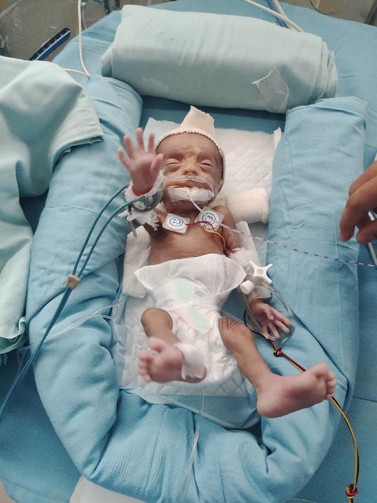 HOW SMALL IS TOO SMALL OUR EXPERIENCE WITH SAVING A 430 GRAM BABY 