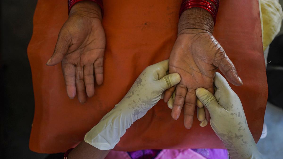 Capturing the cruelty of leprosy in a dark and merciless language
Premium