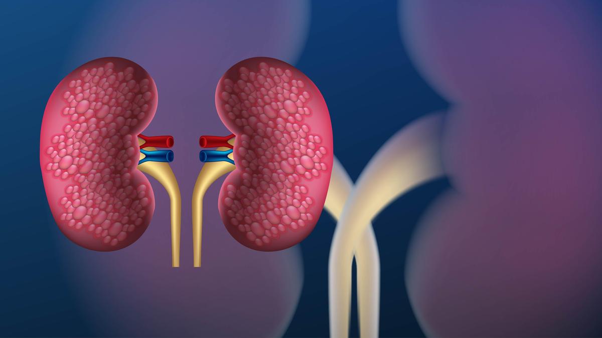 Children are now getting kidney stones: what needs to change to prevent this