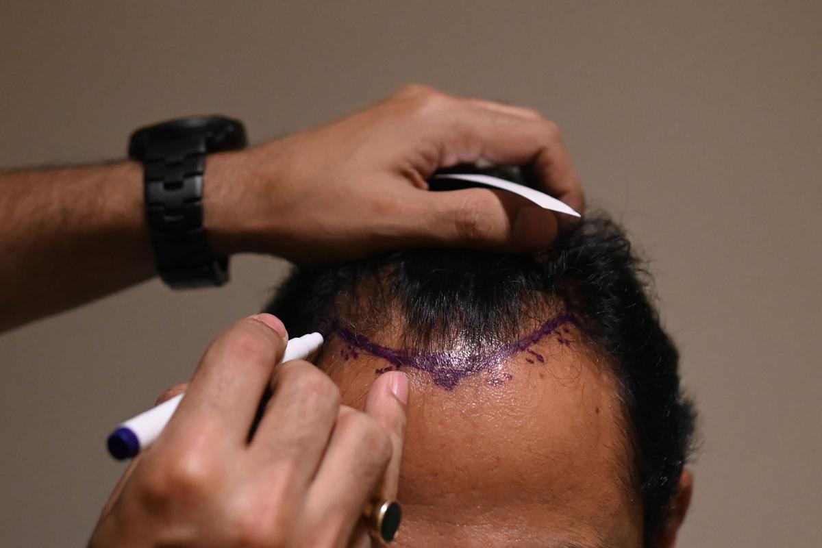 Hair transplant fad turns deadly in India - The Hindu