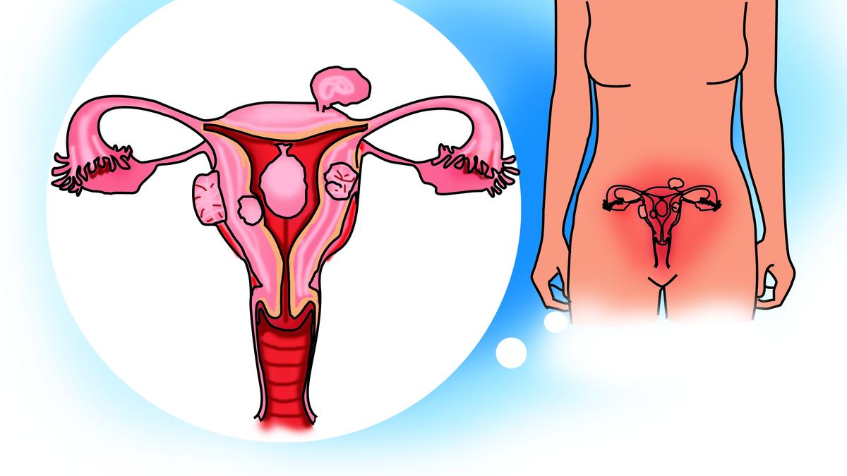 Advances in treatment improve outcomes for women with uterine fibroids, but access remains a challenge, experts say