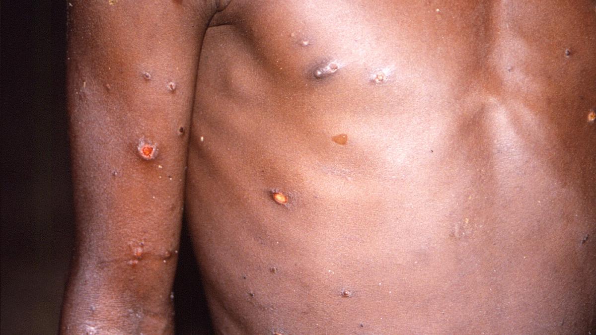 Nigeria CDC has confirmed 21 monkeypox cases this year