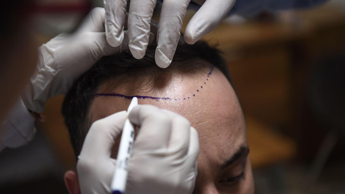IADVL, APSI raise concerns over patient safety in aesthetic and hair transplant procedures