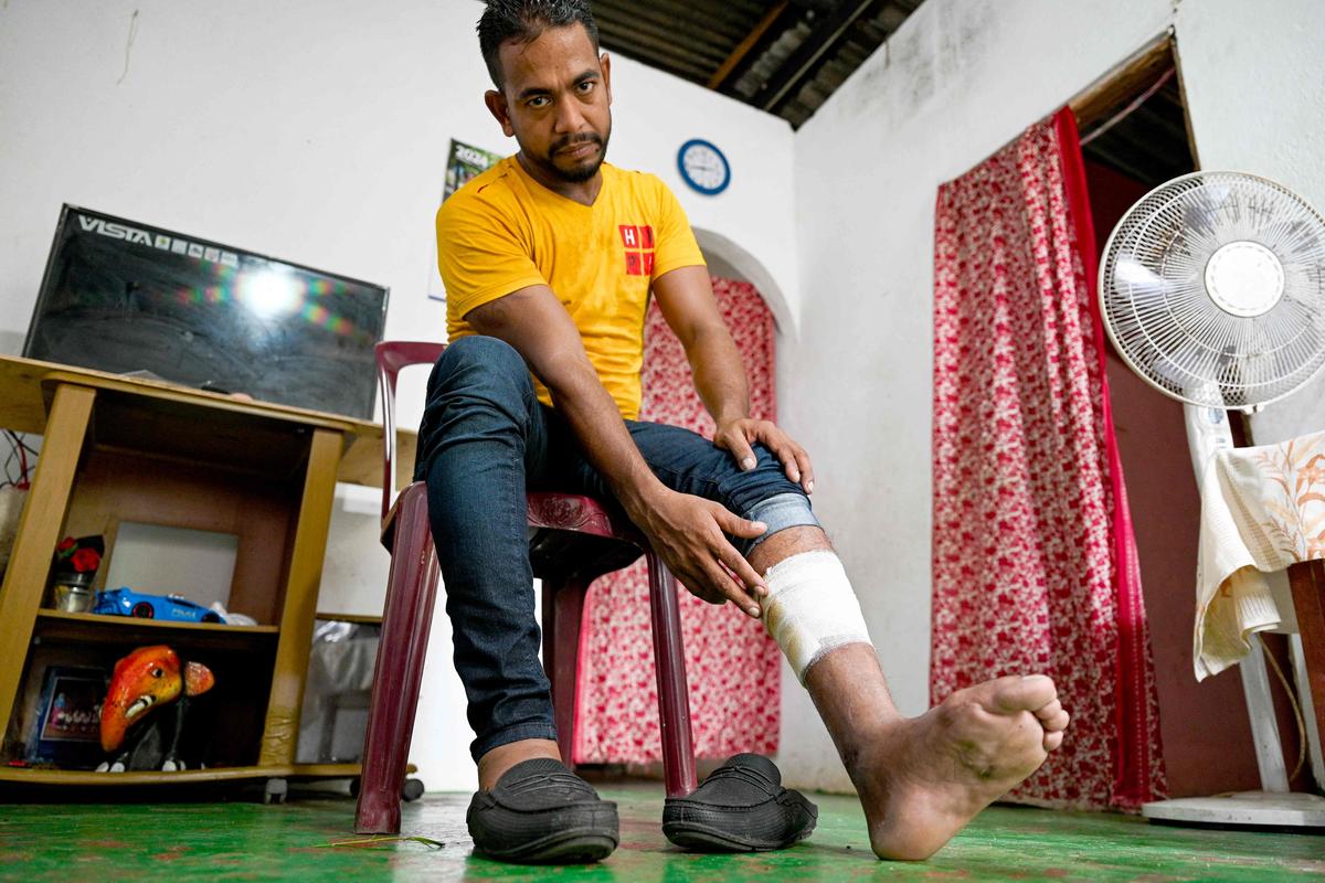 Anil Madusanka, a hotel driver who had joined Russian forces, shows his wound at his residence in Colombo. Anil Madusanka, a hotel driver who had joined Russian forces, shows his wound at his residence in Colombo.
