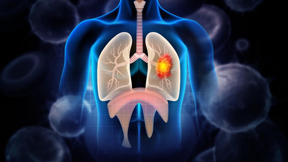 World Lung Cancer Day: Early detection is key to tackling the silent killer, say experts