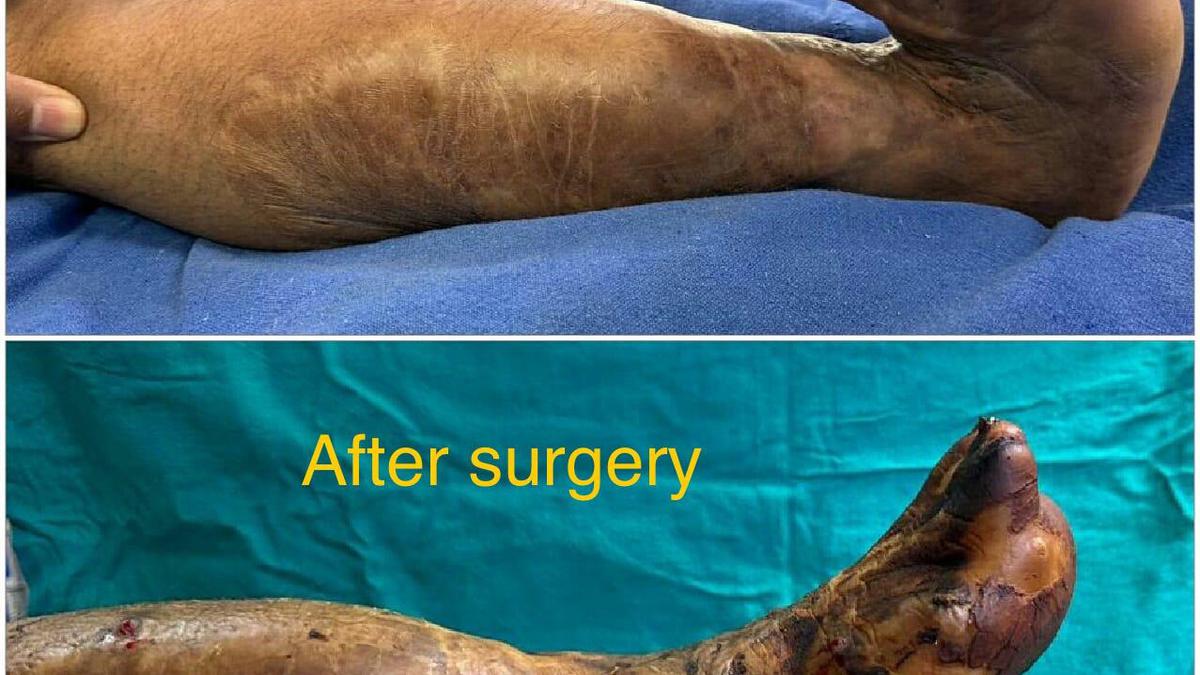 Doctors in Belagavi government hospital successfully treat deformed leg of burns victim using Ilizarov technique