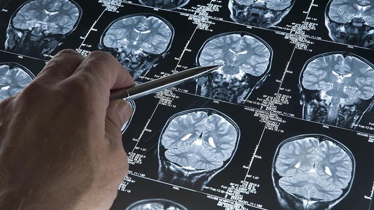 The urgent need to bring stroke rehabilitation into the mainstream