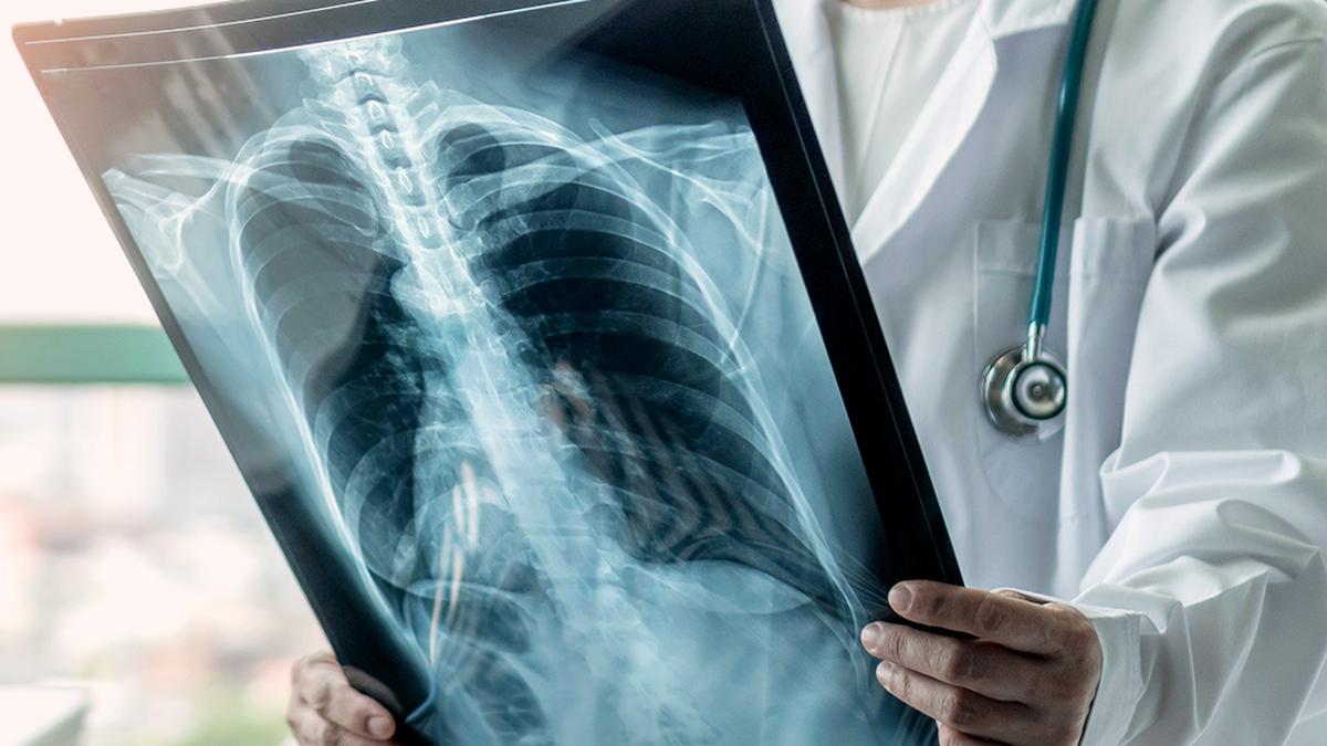 Tuberculosis incidence in Karnataka drops by 40% from 2015 baseline