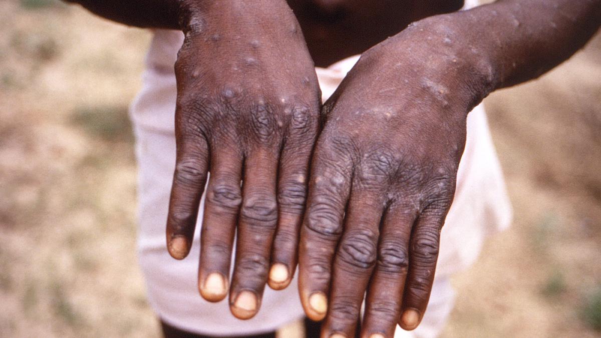 Rare monkeypox outbreaks detected in North America, Europe