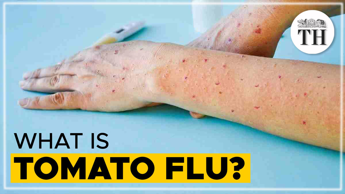 Watch Explained What is Tomato Flu and how is it treated? The Hindu