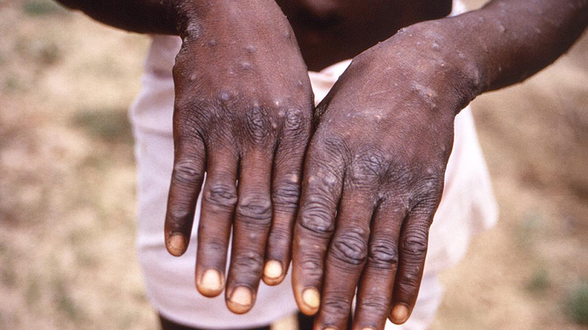 Central team rushed as Kerala reports first monkeypox case