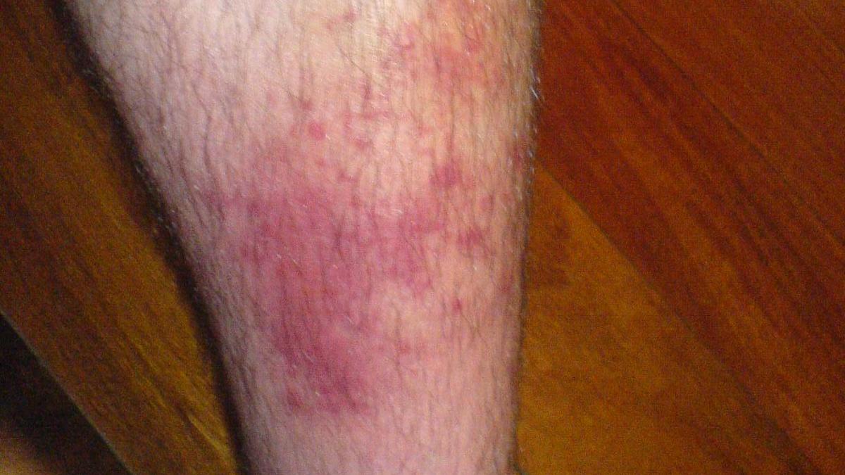 All you need to know about: cellulitis