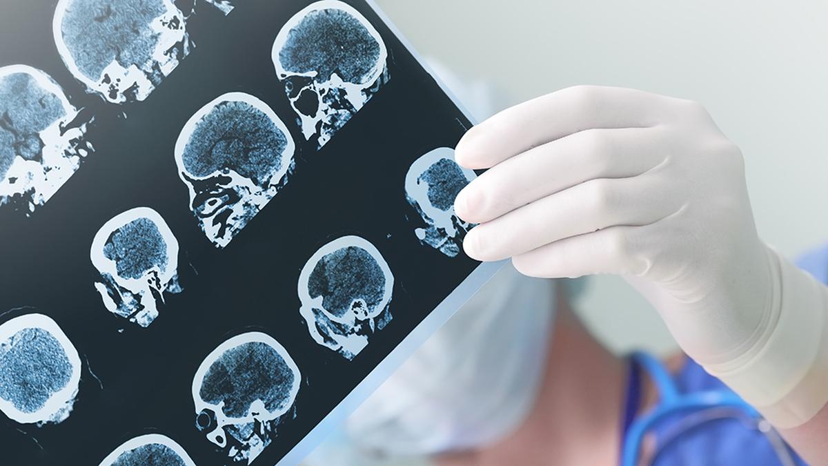 Brain tumours: how much we’ve leant invert the years