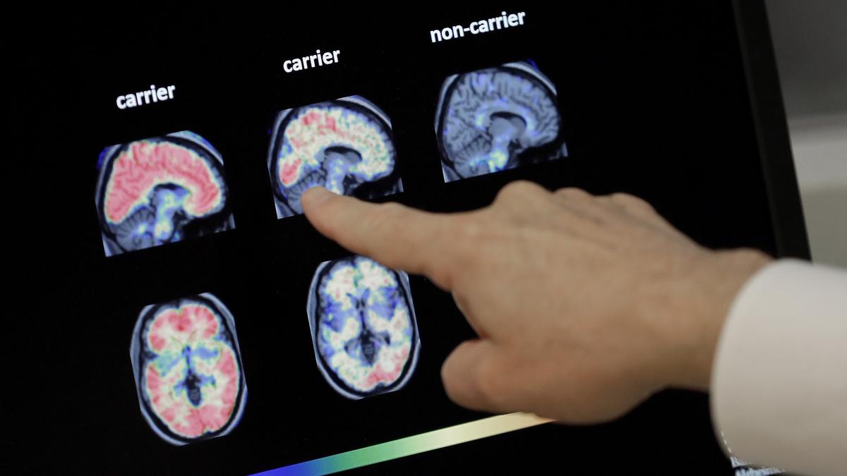 Alzheimer’s disease: Researchers find two cancer drugs reverse damaged gene behaviour in mice​