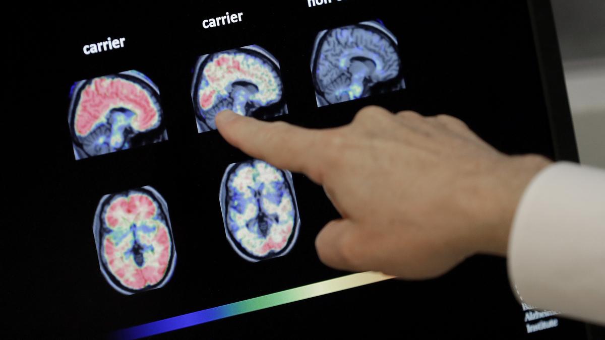 Not all cognitive decline is dementia and not all dementia is Alzheimer’s stress clinicians this brain awareness month