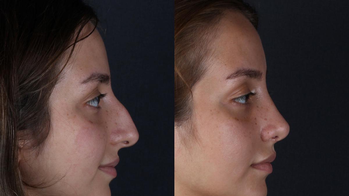 Top 10 Best Nose Job, Turkey, Istanbul Cost Price 2023