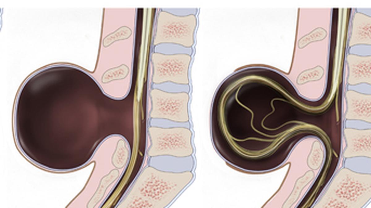 All you need to know about: spina bifida