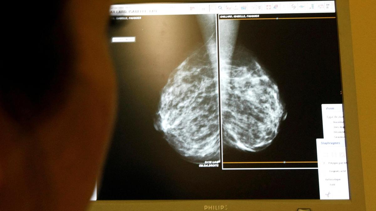 Nearly 13% of women in India with breast cancer experienced metastasis: Study