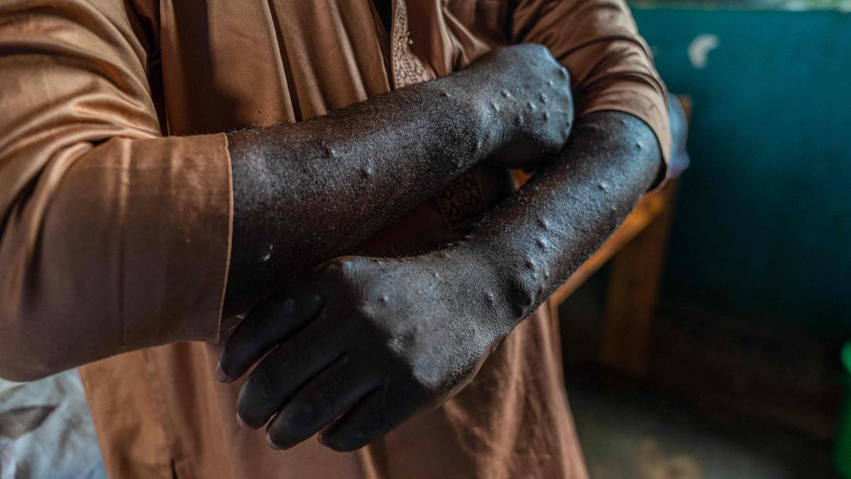 More than $800 million pledged for mpox response, African CDC says