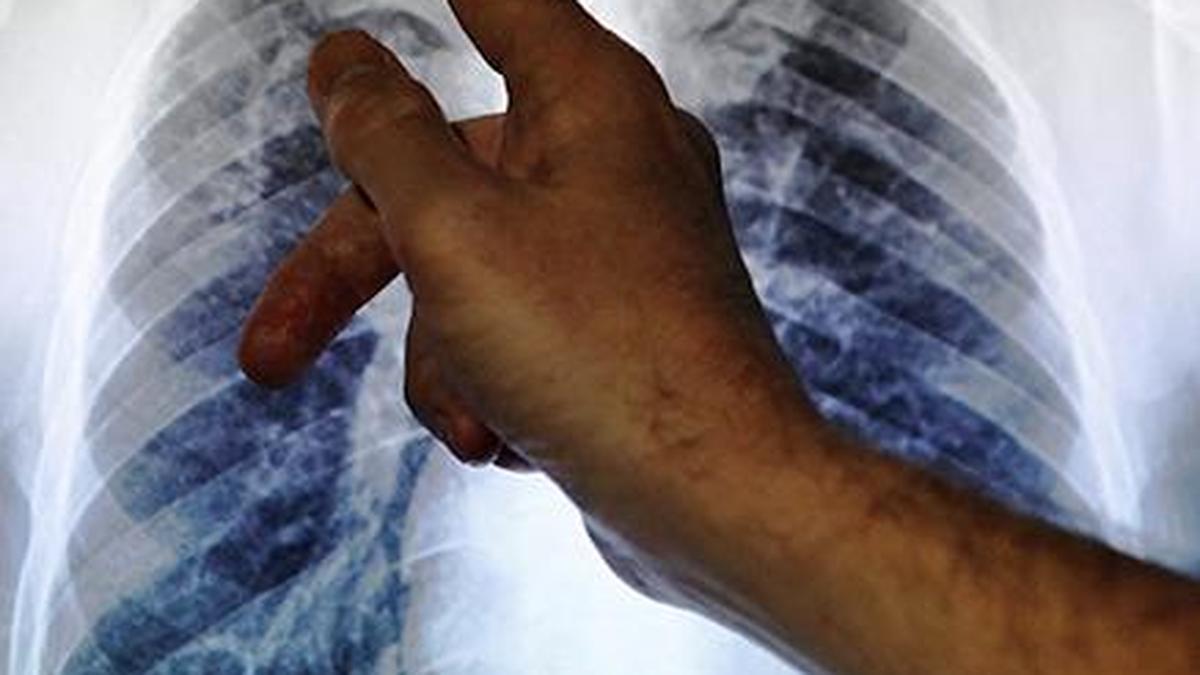 Shorter all-oral TB regimens cost-effective in India: ICMR study