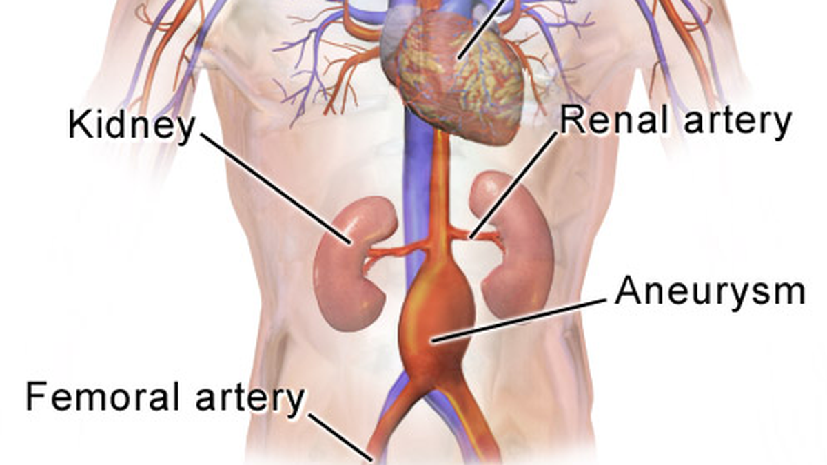 What is an aortic aneurysm: Explained