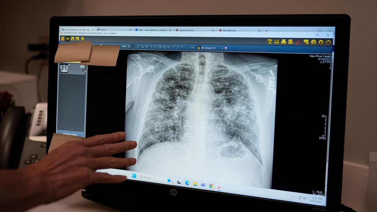 Lung cancer: a scan that detects early and an injection that may prevent it