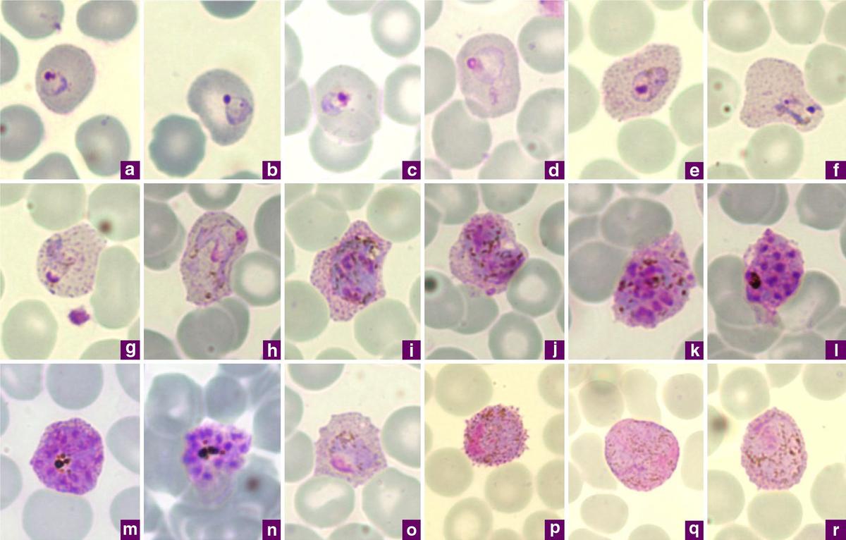 Photomicrographs of Plasmodium vivax in Giemsa-stained thin blood films Photomicrographs of Plasmodium vivax in Giemsa-stained thin blood films