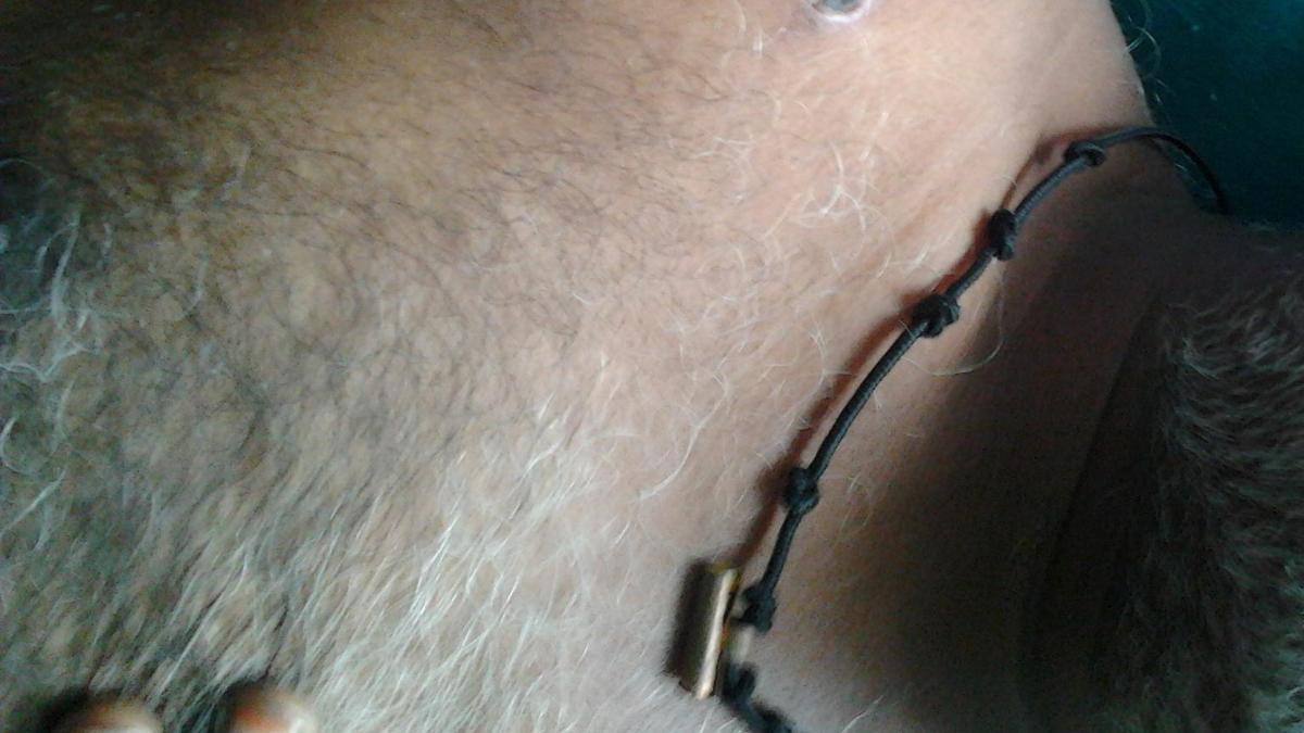 Telangana doctors call for precautions amid scrub typhus spike in Andhra Pradesh