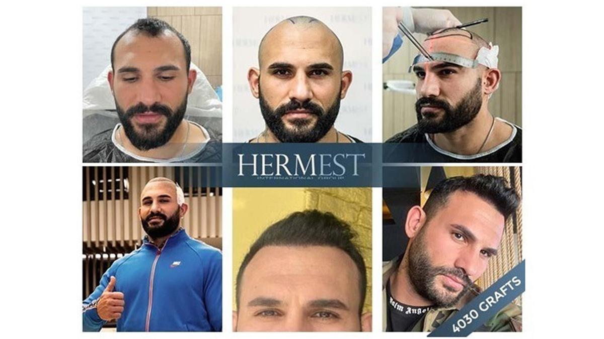 Bodybuilder’s Hair Transplant Journey in Turkey Receives Rave Reviews
