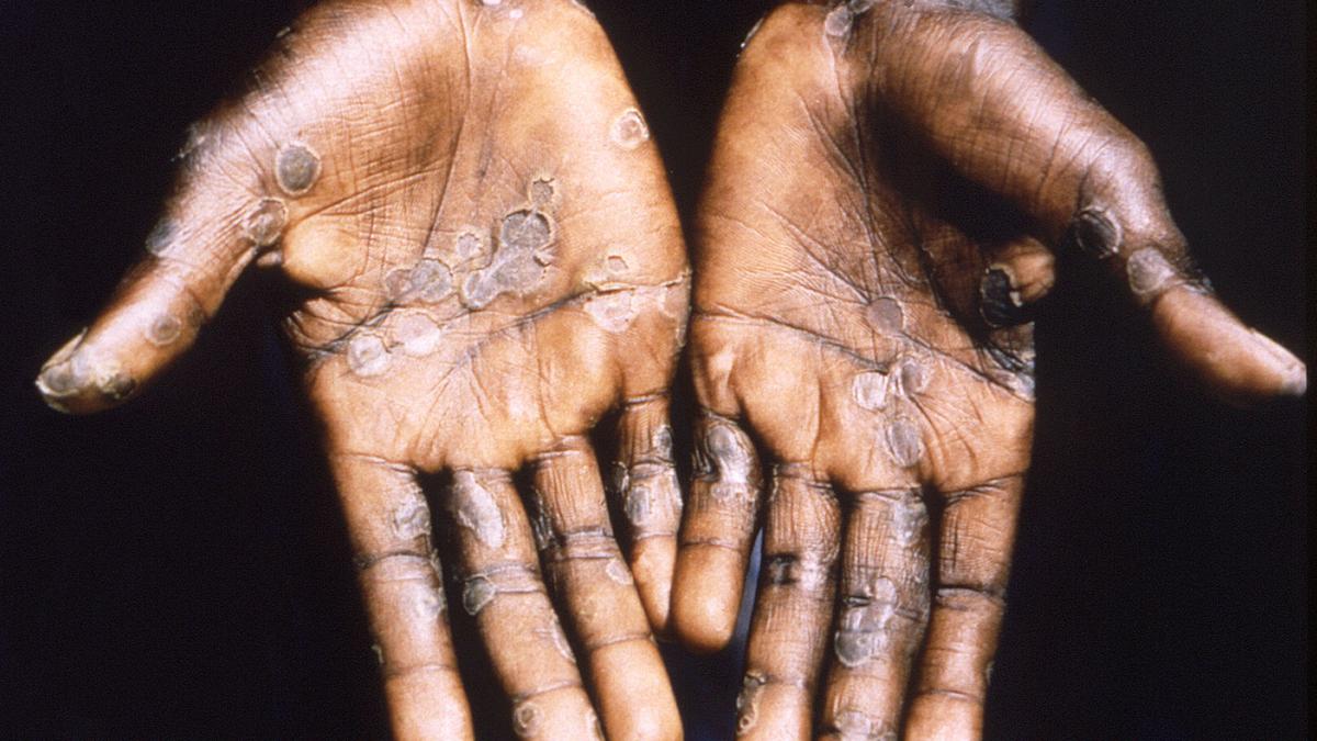 Monkeypox may cause neurological damage, including inflammation of the brain: study