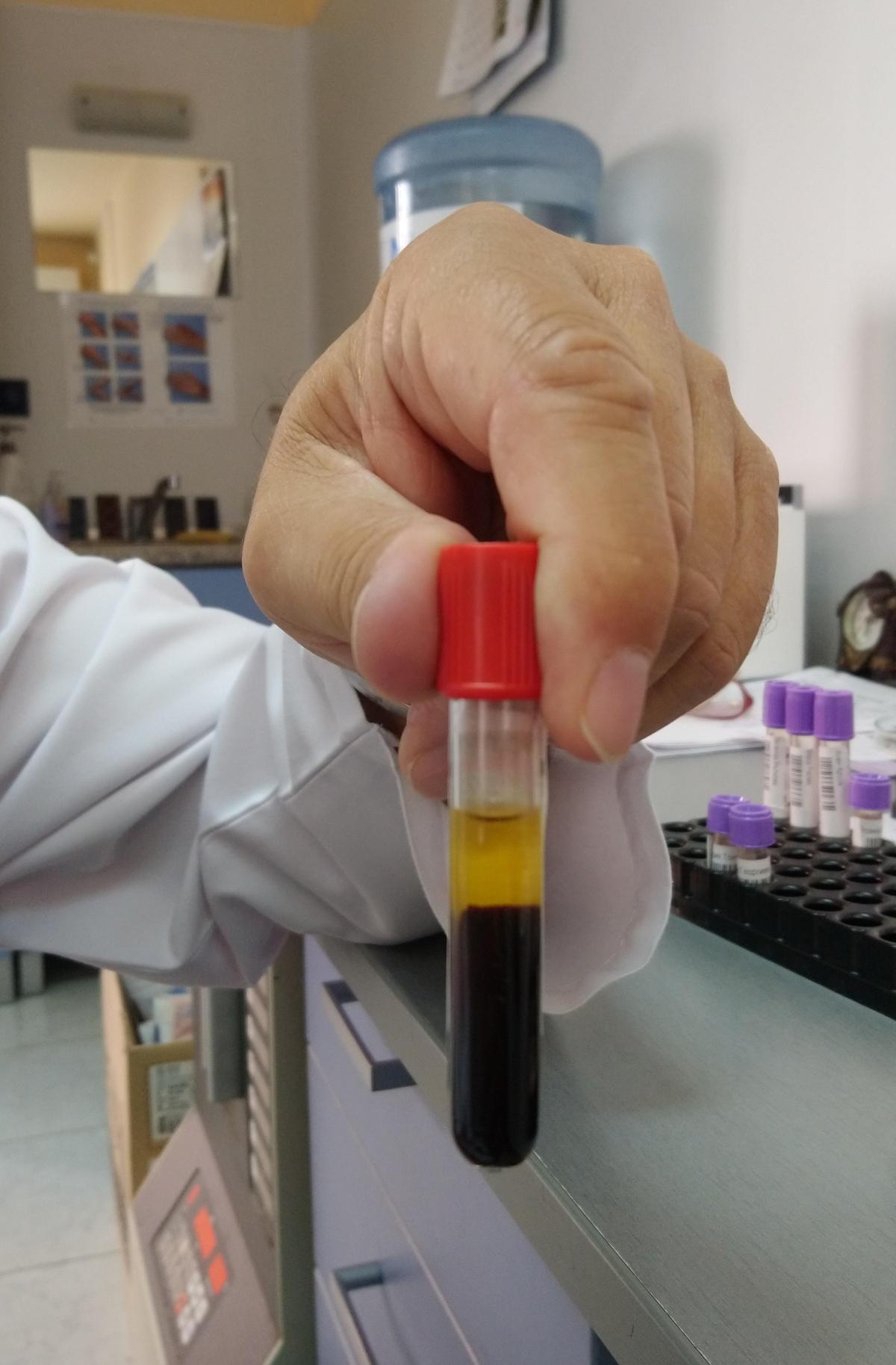 अलग रक्त सीरम (पीला) और एरिथ्रोसाइट्स (गहरा लाल) के साथ रक्त परीक्षण ट्यूब। 