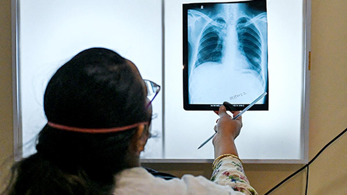 Tuberculosis cases rise for the first time in years, says WHO