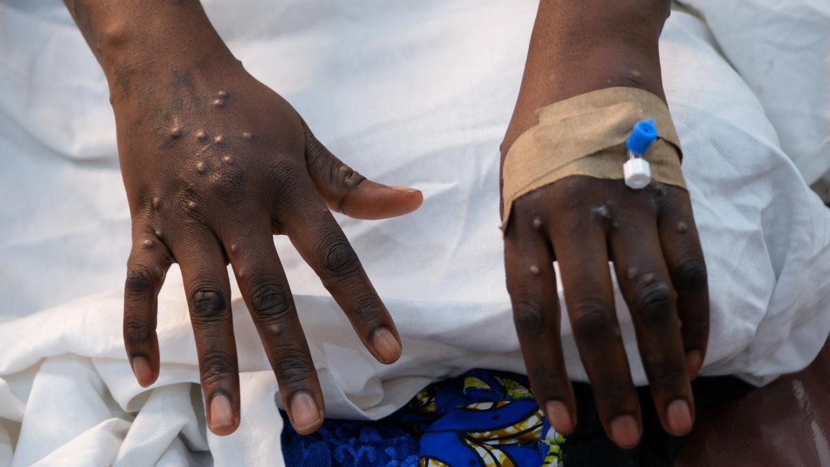 Chickenpox patients lack medicine, food at hospital in eastern Democratic Republic of Congo