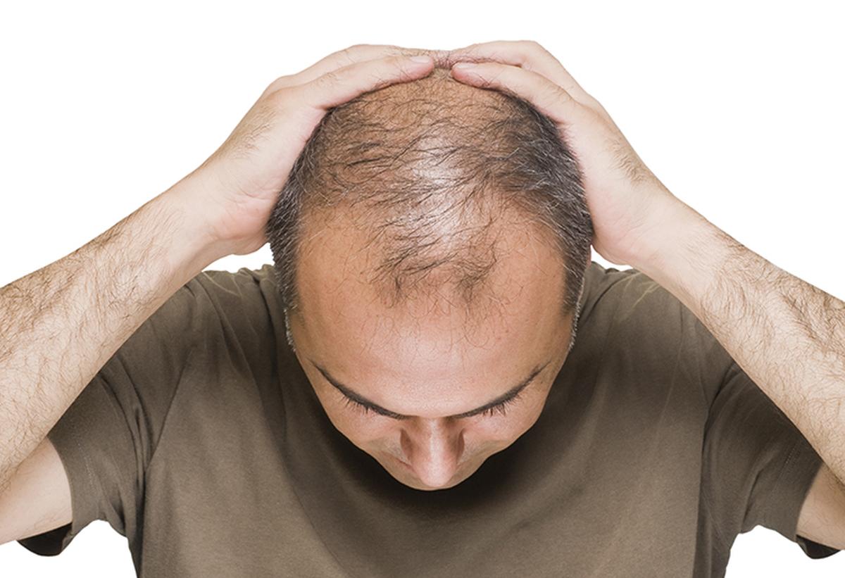 From obsessively checking mirrors to experimenting with miracle oils and dodging pop-up clinics, the journey for most men struggling with baldness can be stressful, costly and even dangerous. Representational image. From obsessively checking mirrors to experimenting with miracle oils and dodging pop-up clinics, the journey for most men struggling with baldness can be stressful, costly and even dangerous. Representational image.