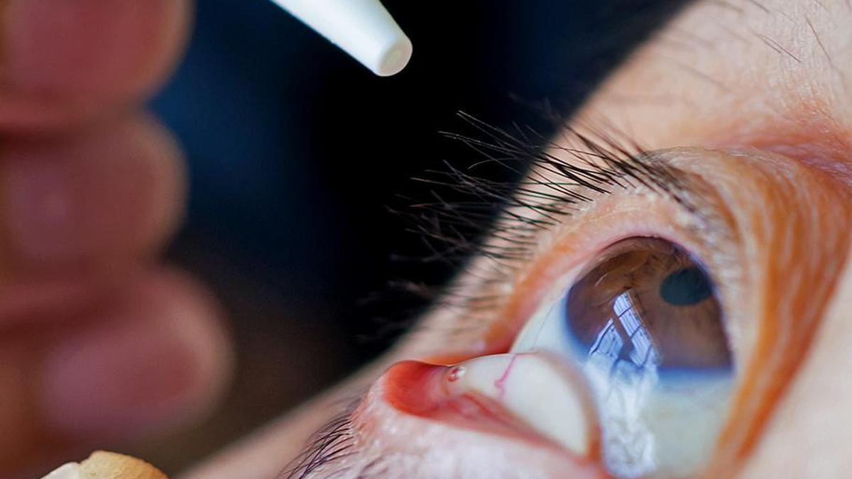 DEOSS International Conference on Dry Eye Disease to be held in Bengaluru on January 31